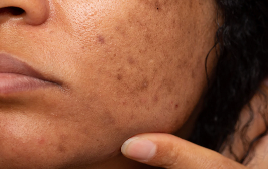 How to Treat Dark Spots Effectively in 2025
